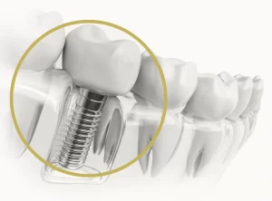 How Dental Implants Work To Improve Your Smile